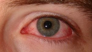 Conjuntivitis